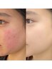 【フォト美顔】シミ、ニキビ、赤ら顔、ハリ、引き締め、透明感UP、アクネケア
