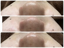 サロン ラズリ 久留米店(SALON Lazuli)/【毛穴洗浄】うる肌革命