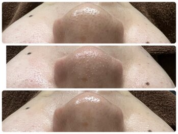 サロン ラズリ 久留米店(SALON Lazuli)/【毛穴洗浄】うる肌革命