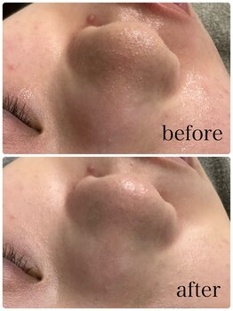 ニコサロン(25salon)/ハイドラ毛穴洗浄