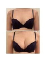 美人バスト 表参道店/バストアップ症例/育乳/1回目