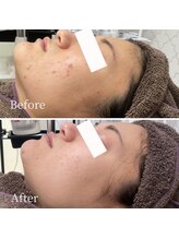 ニキビ研究所 町田店/肌に合わせて施術を変えます！