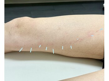 とだ鍼灸院/膝痛★膝の内側が痛い!