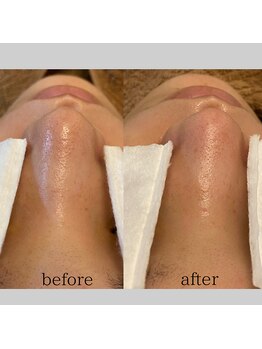 毛穴専科/毛穴洗浄で脱!いちご鼻