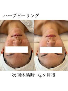 イム(I'm.)/ハーブピーリング before/after