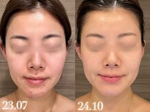 ツグ(tsugu.)の雰囲気（すぐ肌荒れしやすく不安定な肌でしたが今ではノーファンデ肌に）