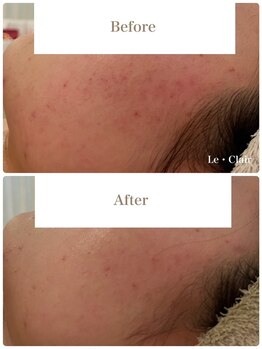 スキンセラピーサロン ル クレール(Le Clair)/Before→After