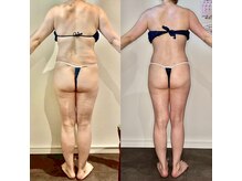 カルナ(CARNA)/【痩身】セルライトゼロ2