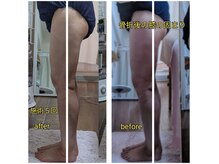 紬(TSUMUGI)/曲がって固まった膝の伸展