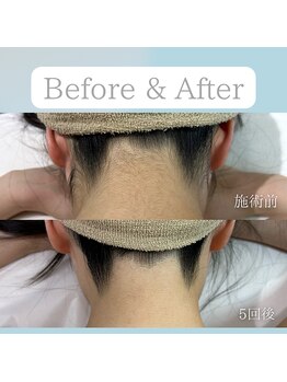 ニコ(Nico)/うなじ脱毛