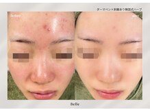 ベル 新橋(Belle)/ハーブ(剥離-あり)×ダーマ