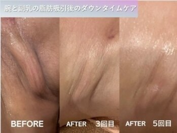 ラディアント(Radiant)/インディバ術後ケア/肌質改善