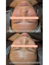 シュシュ(chouchou)/肌質改善