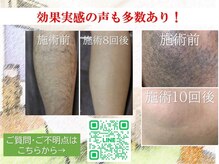 メモリー(memory)の雰囲気（【効果実感の声多数！】最新機器で濃い毛にも対応！抜け感◎）