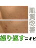 【肌質改善×ニキビケア】繰り返すニキビケア専用