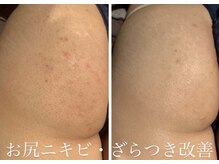 ルアナアイナ(Luana Aina)/お尻ケア/ハーブピーリング