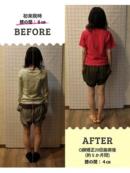 ライフファン鍼灸接骨院 みらい平(Life Fun鍼灸接骨院)/О脚矯正!!