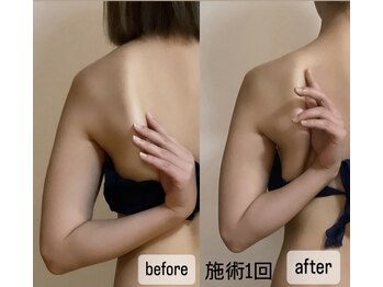 ドゥ カルム(de Calme)の写真/慢性的な首肩こり改善におすすめ◎肩甲骨美人も目指せます☆インディバボディ◆【上半身集中100分¥10000】