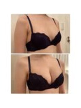 美人バスト 表参道店/バストアップ症例/育乳/1回目