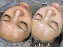 オンダム 表参道(ONDAM)/直後の透明感にみんなびっくり！