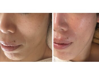 クラージュ(Courage)の写真/【40.50代の口コミ高評価!お肌の専門サロン】生ヒト幹細胞がたるみを改善☆