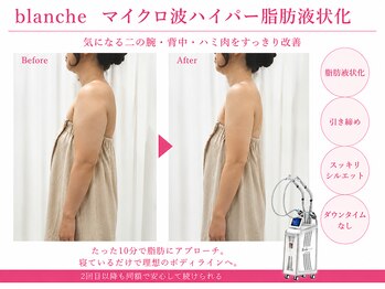 オリエンタルローザ 表参道(Oriental Rosa)/マイクロ波ハイパー脂肪液化術！