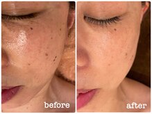 ミラ(Mila)/肌質改善！　before after