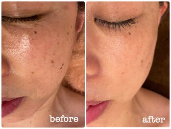 ミラ(Mila)/肌質改善! before after