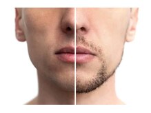 アルリシャ(Alrescha)/メンズ脱毛スタート♪