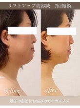 めい鍼灸院/美容鍼灸　ビフォーアフター