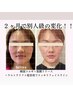 【人気No1】引き上げ&肌悩み解消◎小顔矯正コルギ×選べる光or超音波リフト