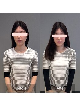 プライミー(PRIMY)/小顔矯正!ビフォーアフター