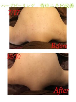 ルアナ 武蔵小杉店(Luana)/背中美人！　ハーブピーリング