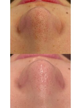 グラサヴォーグ 金沢店/もっちり毛穴に変身♪