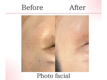 サロンツキ(salon tuki)/光フェイシャル/症例