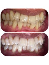 ホワイトニングカフェ 名古屋栄店(WhiteningCafe)/★症例写真