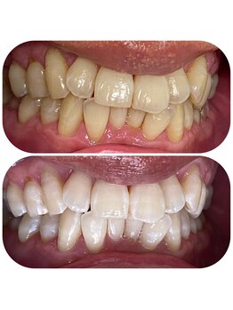 ホワイトニングカフェ 名古屋栄店(WhiteningCafe)/★症例写真