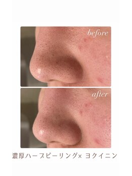 アリュール(ALLURE)/濃厚ハーブピーリング施術効果