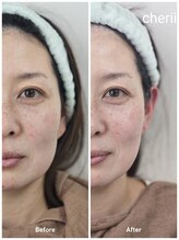 beauty　salon　Cherii【4/1 NEW OPEN（予定）】/光フェイシャル　施術１回目