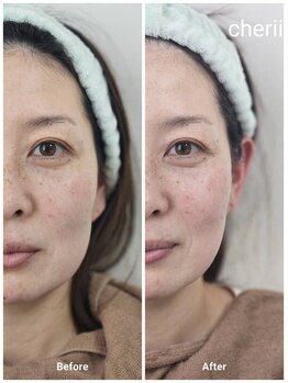 beauty　salon　Cherii【4/1 NEW OPEN（予定）】/光フェイシャル　施術１回目