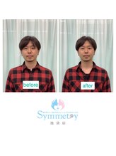 シンメトリー 池袋店/小顔矯正ビフォーアフター