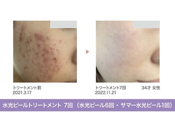 ボーソリューション(Beau-Solution)/【ニキビケア満足度90％以上】