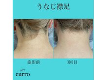 アクト クロ(ACT curro)/【うなじ襟足】脱毛施術例