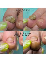 巻き爪補正店 大阪なんば店/変形爪再生術