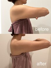 アモリール(Amolir)/上半身痩身　　４０代のお客様