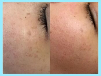 ハーブピーリング 名古屋/TETEピール導入★