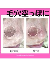 ピアリーノ(Pialino)/ハイドラ毛穴洗浄