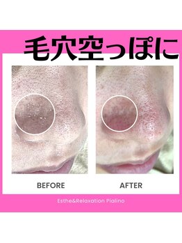ピアリーノ(Pialino)/ハイドラ毛穴洗浄