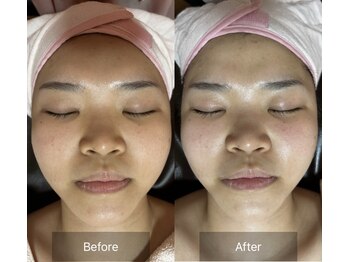 トータル フィルシャイン(Total Fillshine)/うるツヤ水光肌☆水素肌管理