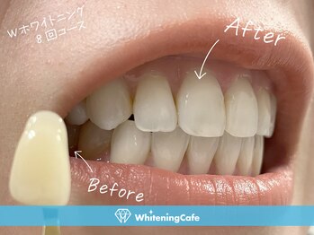 ホワイトニングカフェ 神戸三宮本店(WhiteningCafe)/◎歯のホワイトニング施術写真◎
